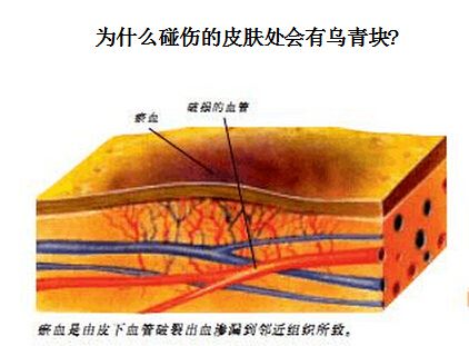 为什么碰伤的皮肤处会有乌青块